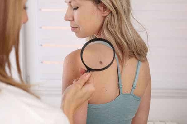 What Are Traditional Skin Lesion Removal Methods Kenilworth?