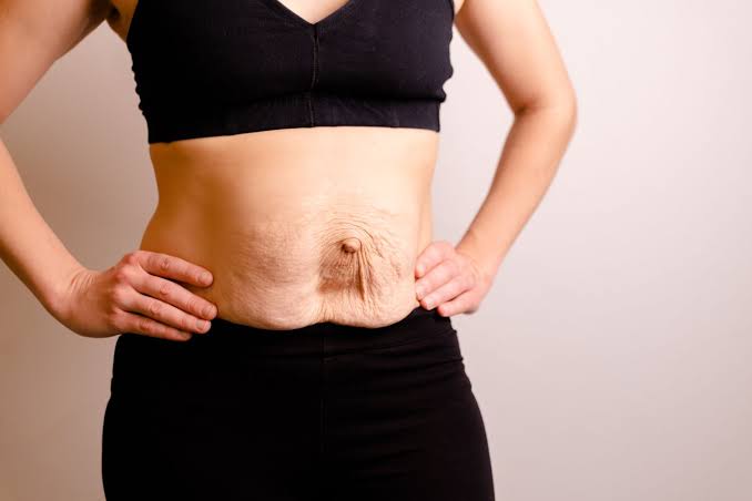Is Surgery Really the Only Way to Repair Diastasis Recti Kenilworth?
