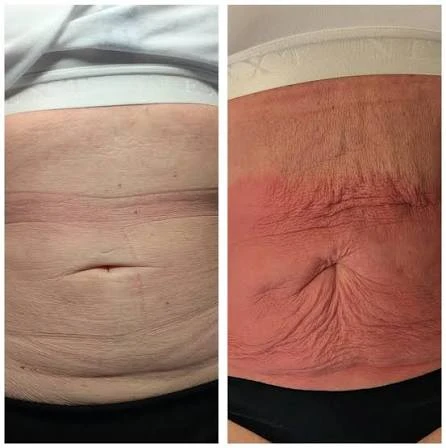 How Does RF Microneedling Improve Crepey, Thin and Uneven Skin Texture Kenilworth?