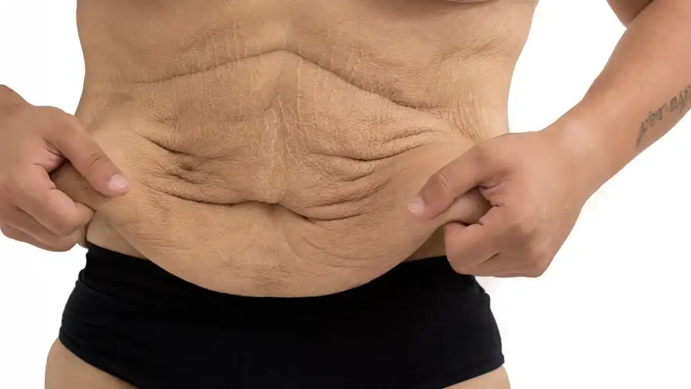 RF Microneedling for Loose Skin: How Can It Help Tighten and Reshape the Skin Kenilworth?